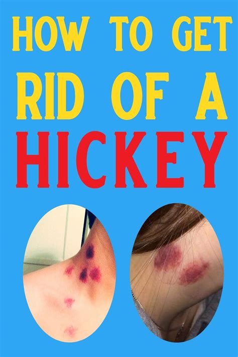 How To Get Rid Of A Hickey – Wall Art