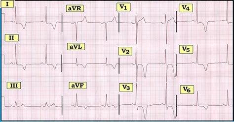 ECG Review: The Cause of T Wave Inversion? |… | Relias Media