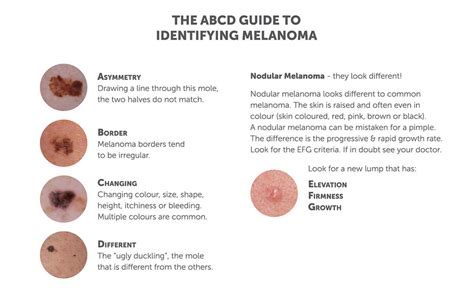 Detecting and Treating Melanoma - Utah Valley Dermatology