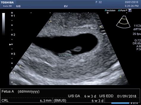 25 Weeks Pregnant Ultrasound