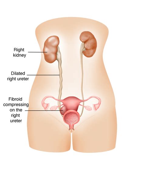 apa itu fibroid - Molly Cameron