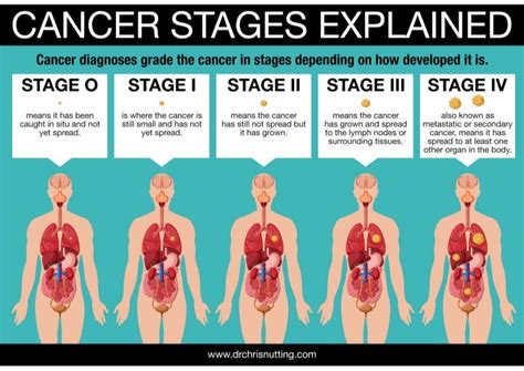 Dr Chris Nutting - Cancer Stages Explained