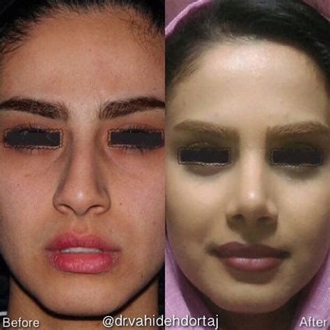 Deviated Septum Post Surgery (2) » Rhinoplasty: Cost, Pics, Reviews, Q&A