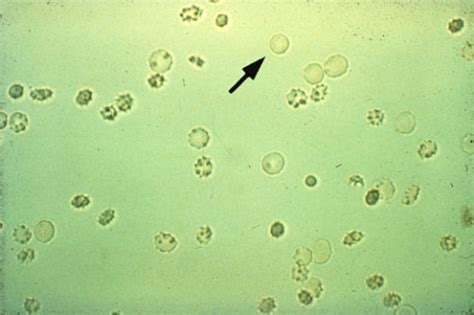 USMLE Pathology Slides - Hematuria with dysmorphic RBCs Note the crenated...