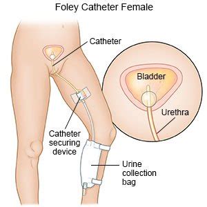 Foley Catheter Removal (Discharge Care) - What You Need to Know