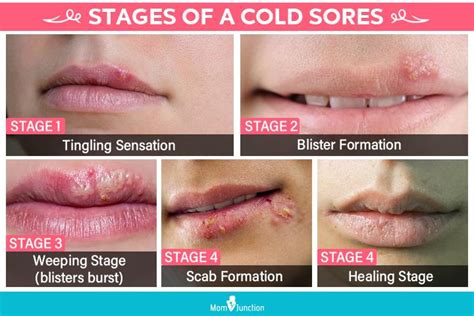 Ausnew Pharmacy | Cold Sores: Symptoms, Causes, Prevention & Treatment