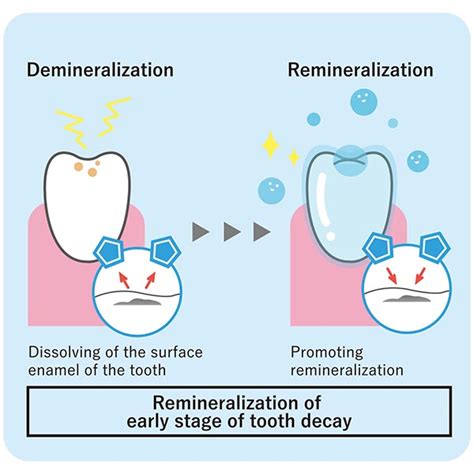 A study on tooth remineralization with a mineral-coated toothbrush | MISOKA LAB.