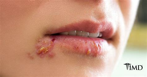 Cold Sore Treatment | 1MD