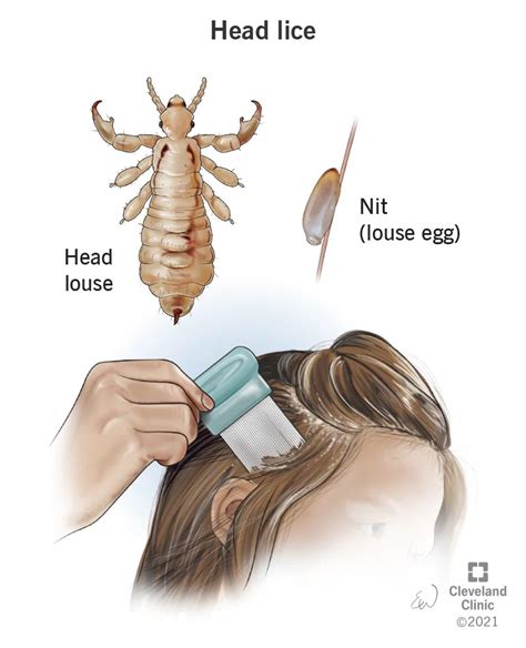 Signs of lice, symptoms, causes and treatment (2022)