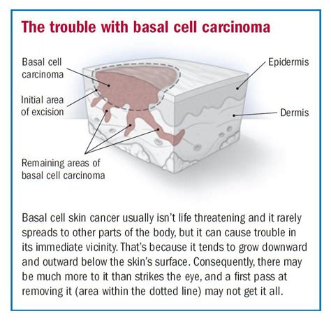 Basal cell carcinoma overview - Harvard Health