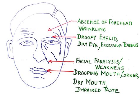 What are causes of Bell's Palsy