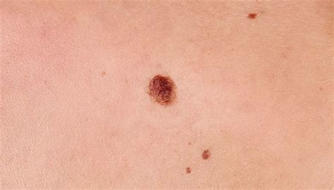 How To Remove Moles | Renew Physical Therapy