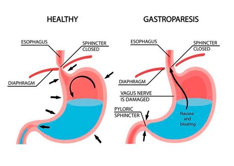 Let's talk about Gastroparesis ️