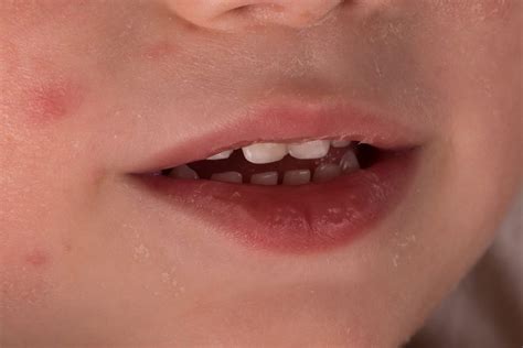 How to handle teething rash? | Trilliant Dentistry