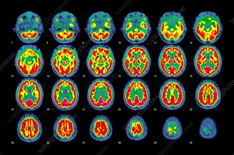 Normal brain activity, PET scans - Stock Image C026/7614 - Science Photo Library