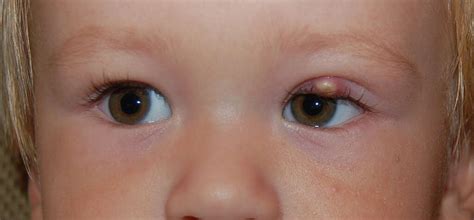 Eye Diseases: 10 Common Eye Diseases