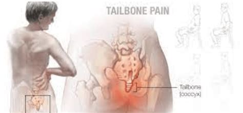 Coccydynia/ Tailbone Pain Treatment Pune - Dr Deshmukh's Pain Clinic Pune