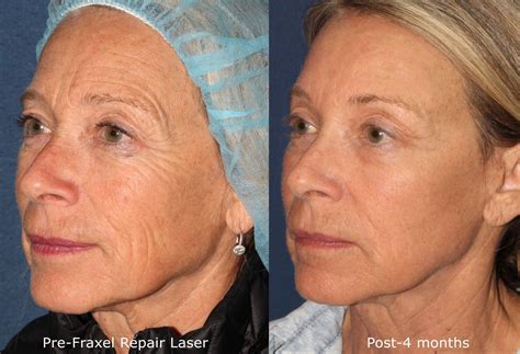 Best Before and After Dermatology Treatments in San Diego | CLDerm | Laser face treatment, Face ...