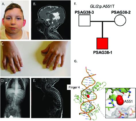 De novo mutation in GLI2. (A) The proband at 8 y of age, demonstrating ...