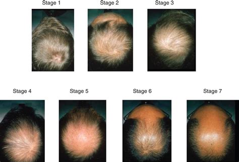 Hair Loss In Women & Men - Causes, Diagnosis & Hair Loss Treatment