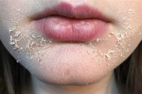 Why it is dry skin around mouth? Learn Causes and Cure Naturally