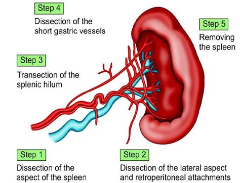 Splenectomy – Surgery for the removal of spleen