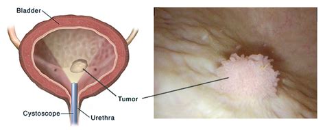 Bladder Cancer: Causes, Signs, Symptoms, Diagnosis and Stages | Saint John’s Cancer Institute ...