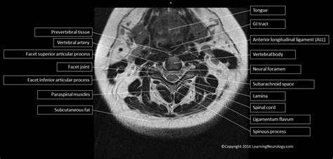 Approach to MRI Spine | LearningNeurology.com