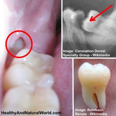 Wisdom Tooth Pain Relief: The Top 10 Home Remedies