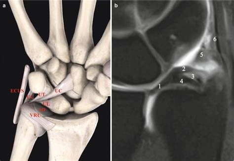 Ulnar Collateral Ligament Wrist Mri