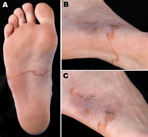 Practice Tip: Cutaneous larva migrans | This Changed My Practice (TCMP) by UBC CPD