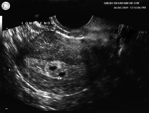 Pregnancy Ultrasound Pictures At 3 Weeks