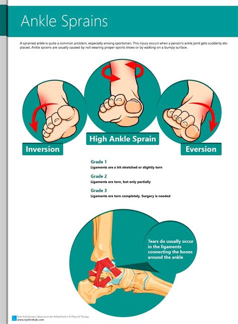 Ankle Sprains causes and symptoms. Ankle sprain grades