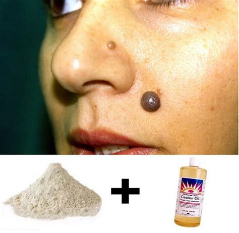 At Home Mole Removal: Natural Home Remedies For Successful Elimination Of Moles