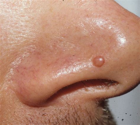 Papule or fibrous papules on nose causes, diagnosis & papule treatment