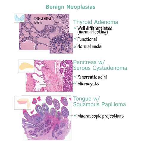 Pathology Glossary: Neoplasm Histology | Draw It to Know It