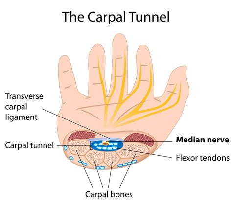 Carpal Tunnel Syndrome