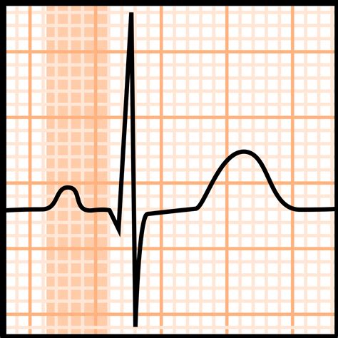 PR Interval | CardioSchool