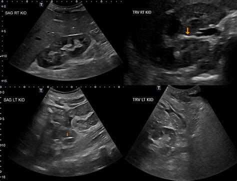 Pyonephrosis Ultrasound