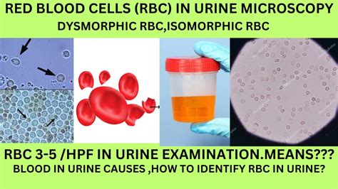 RBC IN URINE MICROSCOPY.CAUSES OF RBC IN THE URINE. DYSMORPHIC RBC ,ISOMORPHIC RBC,GHOSTRBC IN ...