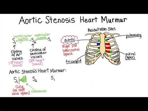 Aortic Stenosis Murmur