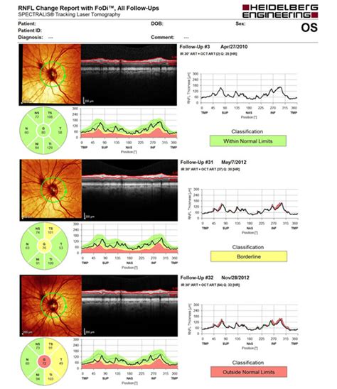 Heidelberg Spectralis OCT - Burnett Hodd & Tam Optometry