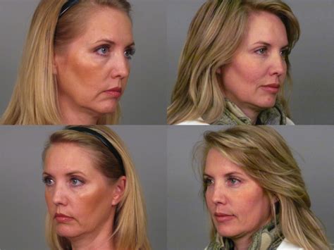 Botox Before After Photo Gallery Atlanta | Roswell GA