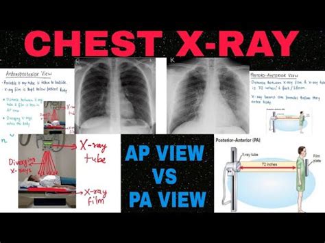 Chest Xray : PA vs AP view - YouTube