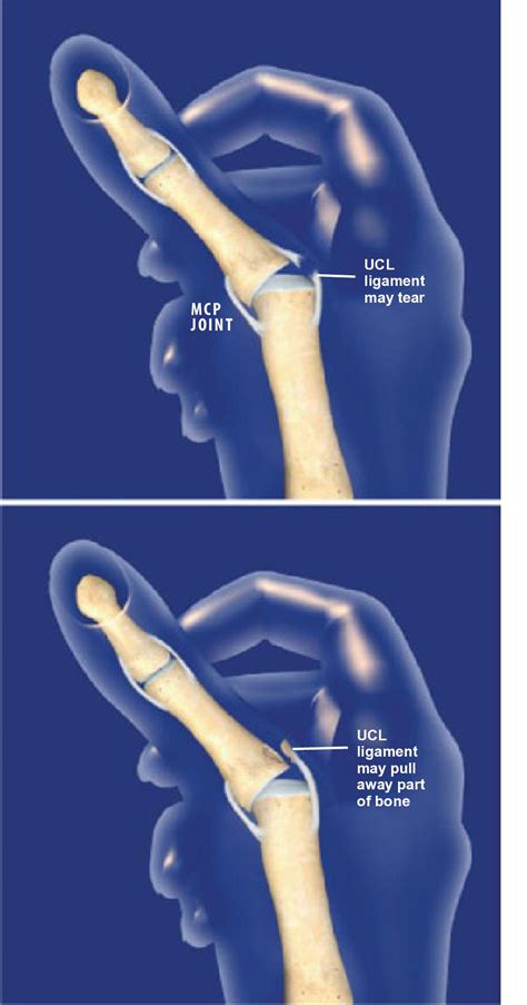 Ulnar Collateral Ligament Thumb Splint