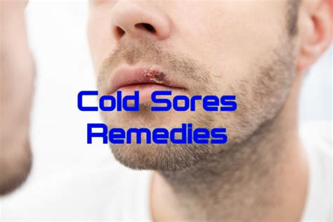 10 Home Remedies for Cold Sores - Home Remedies App