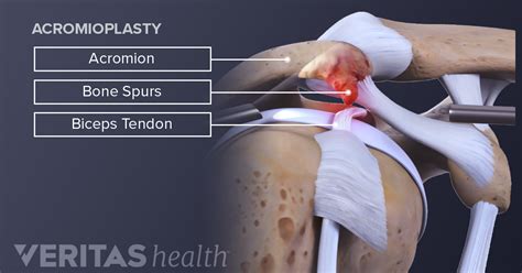 Bone Spur Shoulder Surgery Recovery Exercises - Exercise Poster