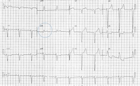 Lbbb Stemi Criteria