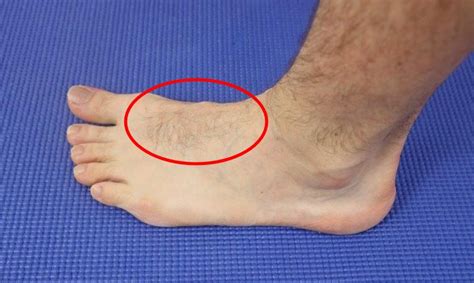 Pain On Top Of Foot: [Causes, Symptoms & Best Treatment!]