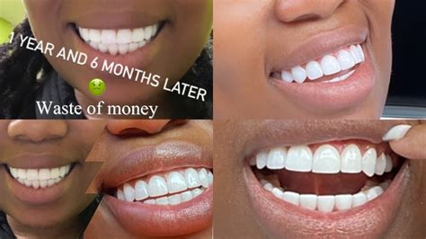 Good Veneers Vs Bad Veneers